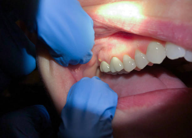 Best Emergency Tooth Extraction in South Bay, FL