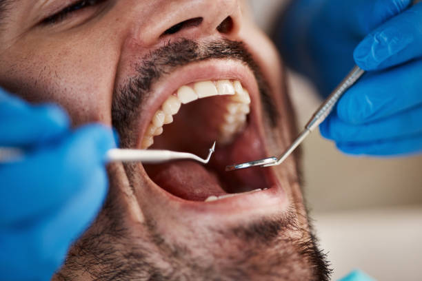 Best Emergency Gum Treatment in South Bay, FL