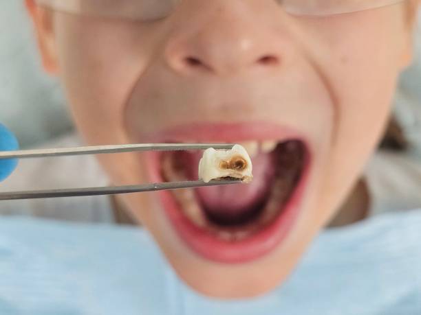 Best Emergency Dental Care for Broken or Chipped Teeth in South Bay, FL
